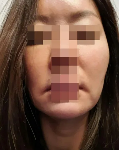 拉提 | 脂肪手術心得