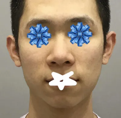 鼻 | 臉部輪廓 手術心得