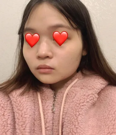 鼻 | 臉部輪廓 手術心得