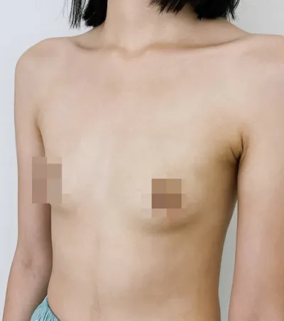 魔滴術後一個月）建議趁年輕的時候做！（長文慎入）