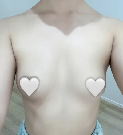 曼陀 Xtra + 副乳切除) 1個月大滿意心得