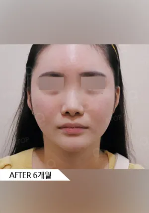 After