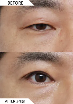Before