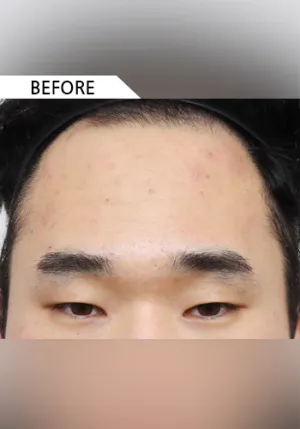 Before