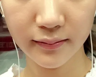 果然 Thermage 還是技術啊。