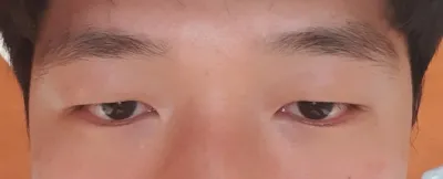 切開式眼部矯正