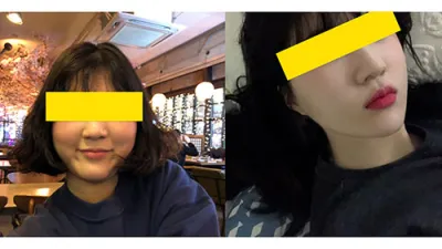 顏面輪廓 - 做了顴骨縮小手術！