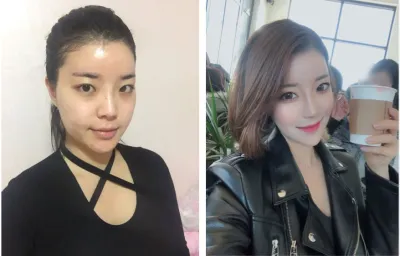 我在婕伊俊做了輪廓四種手術~