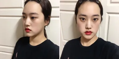 我做了下顎角縮小、下巴、皮質骨切除術和隆鼻手術！==== 3333