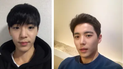 做了眼部矯正和開眼角，以及鼻部手術。