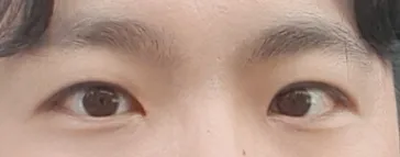 做了男性眼部矯正（包含開眼頭，切開）~！！