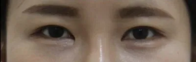 #雙眼皮(埋線) #眼部重修