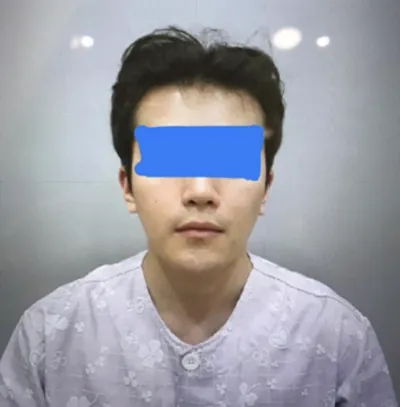 方下顎、顴骨縮小、下巴、皮質骨切除、維納斯雷射、輪廓注射