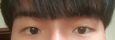 部分切開眼瞼下垂矯正修復手術