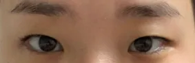 雙眼皮（埋線）、開眼頭
