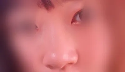 我在Jayjun整形外科打了鼻子填充劑:)