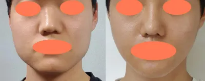 方下巴、皮質骨切除、咬肌縮小