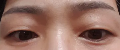 雙眼皮（切開）