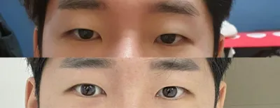 眼部矯正（部分切開）、開眼頭