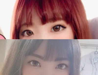 雙眼皮（埋線），開眼頭