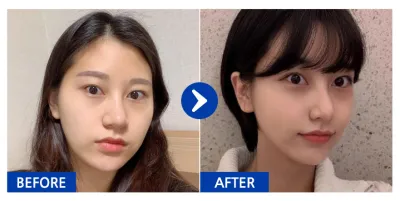 [Babytalk] 臉部輪廓、脂肪移植 / 第6個月 / 暱稱：阿美利卡諾