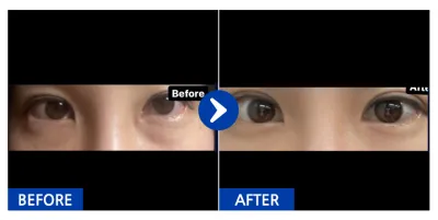 [Babitalk] 雙眼皮 / 1個月 / 暱稱：Babitokhi