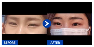 [Babitalk] 雙眼皮 / 第4個月 / 暱稱：活潑女孩