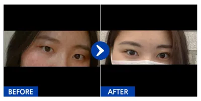 [Babitalk] 雙眼皮 / 術後2個月 / 暱稱：Yurim08