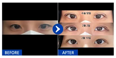 [江南姐姐] 自然黏連 / 1個月 / 暱稱：活刷比亞