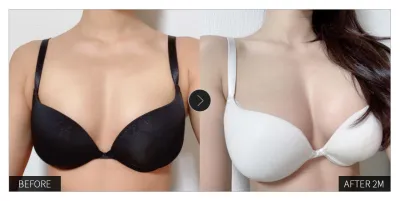 [江南姐姐 心得] 隆乳手術滿兩個月 / 暱稱：우우우나아