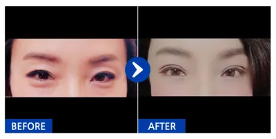 [江南姐姐] 上下眼瞼 / 第1個月 / 暱稱：JONABI555