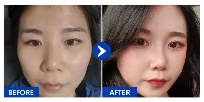 [Babitalk] 隆鼻 / 術後2個月 / 暱稱：暱稱11111