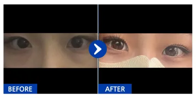[Babytalk] 眼下、雙眼皮（埋線）/ 術後2個月 / 暱稱：언이어니언디
