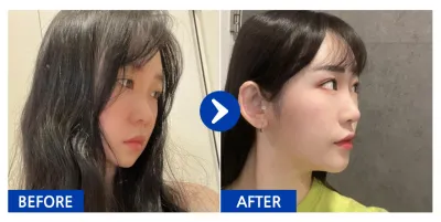 [Babitalk] 隆鼻 / 6個月 / 暱稱：횬니횬니야