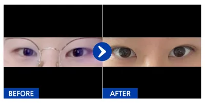 [江南姐姐] 雙眼皮（自然黏連） / 暱稱：juankim