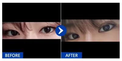 [江南姐姐] 自然黏連 / 第1個月 / 暱稱：紫色毛巾