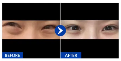 [江南姐姐] 眼底脂肪重新配置 / 第2個月 / 暱稱：dbgcgghgfd