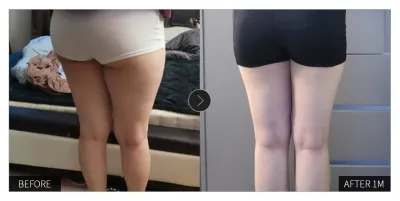 [江南姐姐評價] 抽脂滿一個月 / 暱稱：취저1017