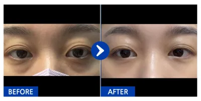 [江南姐姐] 眼底脂肪重置 / 1個月 / 暱稱：隔壁小可愛