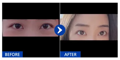 [Babitalk] 眼底脂肪重置 / 1個月 / 暱稱：kd31