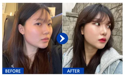 [Babitalk] 隆鼻 / 第10個月 / 暱稱：雪允2