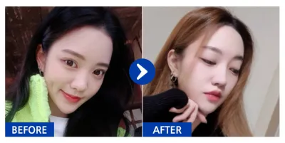 [江南姐姐] 隆鼻 / 6個月 / 暱稱：Gung-tting