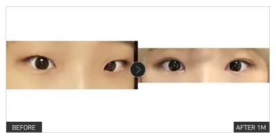 [江南姐姐 心得] 眼部整形滿一個月 / 暱稱：meyh_