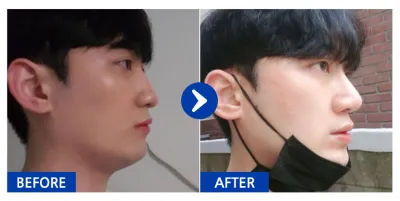 [江南姐姐] 隆鼻 / 第6個月 / 暱稱：核奎