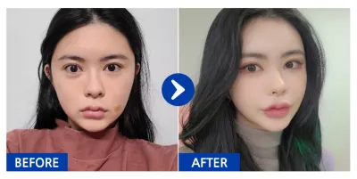 [江南姐姐] 脂肪移植 / 第5個月 / 暱稱：ooaa.a