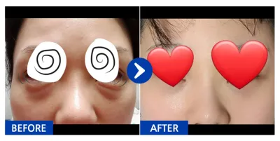 [江南姐姐] 眼底脂肪重新配置 / 第3個月 / 暱稱：喵紅