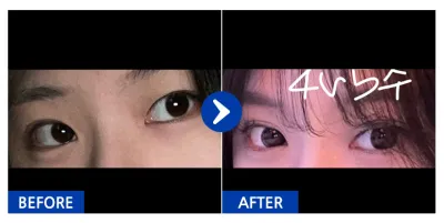 [江南姐姐] 眼部整形 / 第1個月 / 暱稱：薄荷巧克力珍珠奶茶