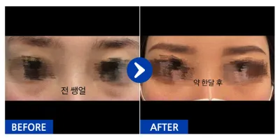 [江南姐姐] 眼底脂肪重置 / 1個月 / 暱稱：쑈롱