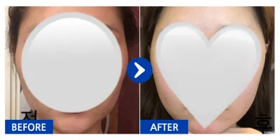 [江南姐姐] 臉部輪廓 / 第1個月 / 暱稱：daldal2