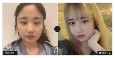 [Babitalk 心得] 眼部整形、輪廓整形一個月 / 暱稱：Jiwaring